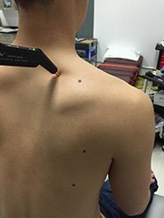 Electrical stimulation being conducted on a patient