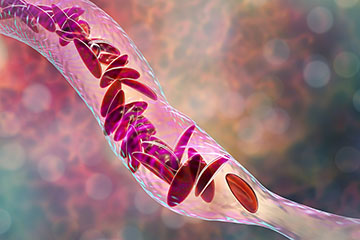 11367_GEN_CHP_Sickle cell disease and falling_24 360x240