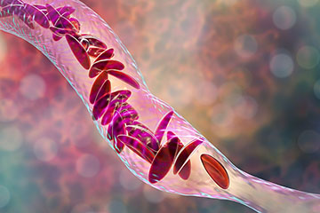 Red blood cells in the C-curve shape associated with sickle cell disease moving through a blood vessel.